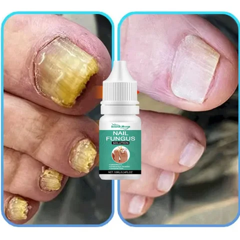 Эссенция для лечения грибка ногтей