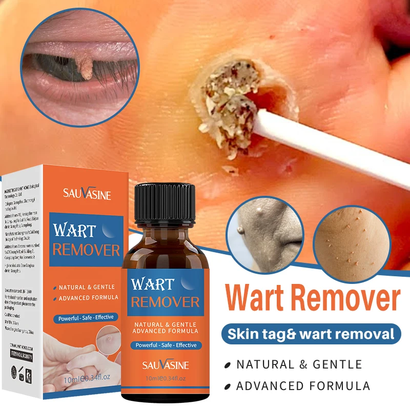

10ml Wart Tag Removal Essential Oil Organic Tags Solutions Serum Painless Mole Skin Dark Spot Remover Freckle Warts Treatment