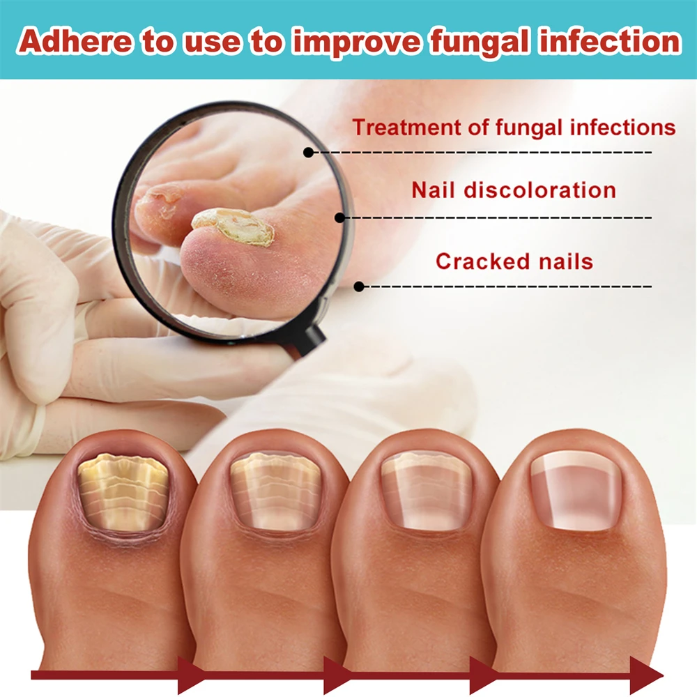 

16 шт., пластырь для удаления гвоздей с ногтей