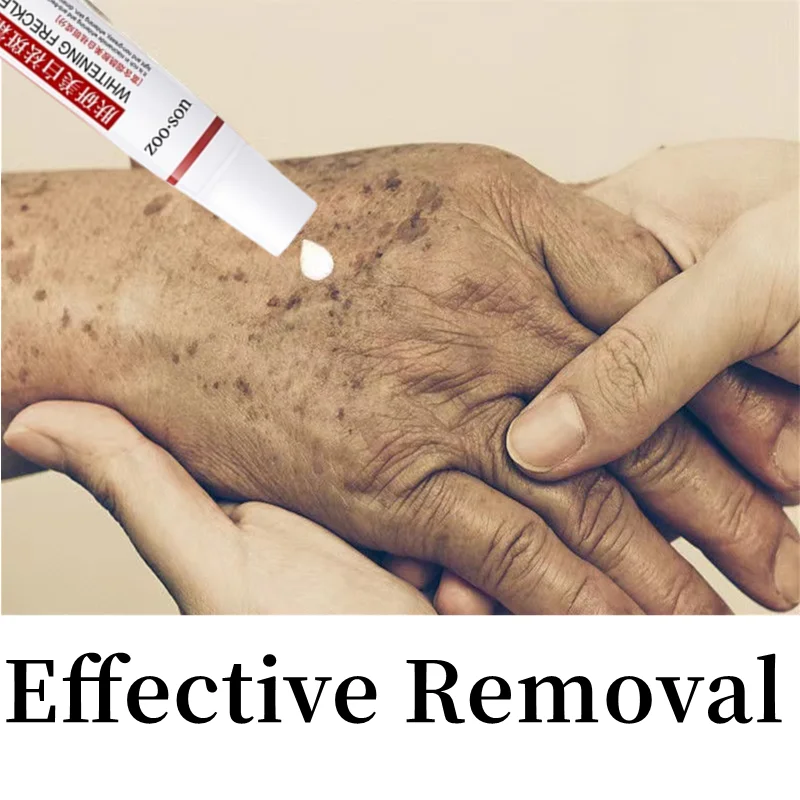 

20g Effective Freckle Cream Remove Melasma Dark Spots Whitening Melanin Corrector Treat Acne Scars Brighten Lightening Cream