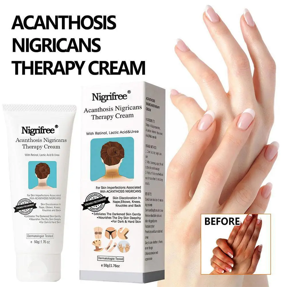 

Acanthosis Nigricans Therapy Cream Whitening Body Cream Removal Of Hyperpigmentation For Dark Body Parts Like Neck Ankles N8J1