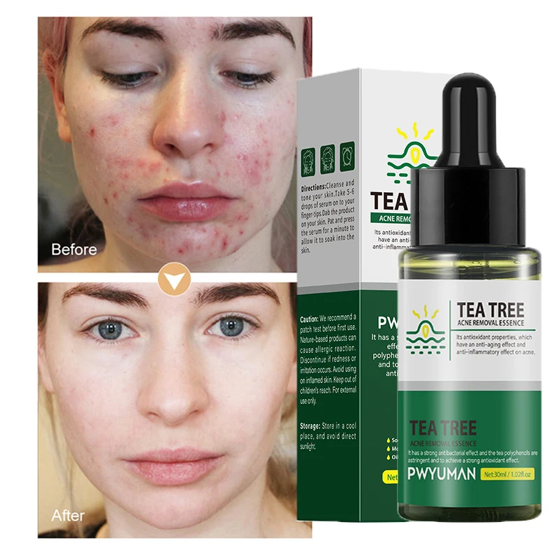 

Tea Tree Acne Removal Essence Effective Moisturizing Oil Control Smoothing Skin Fade Acne Marks Firm Shrink Pores Care Products