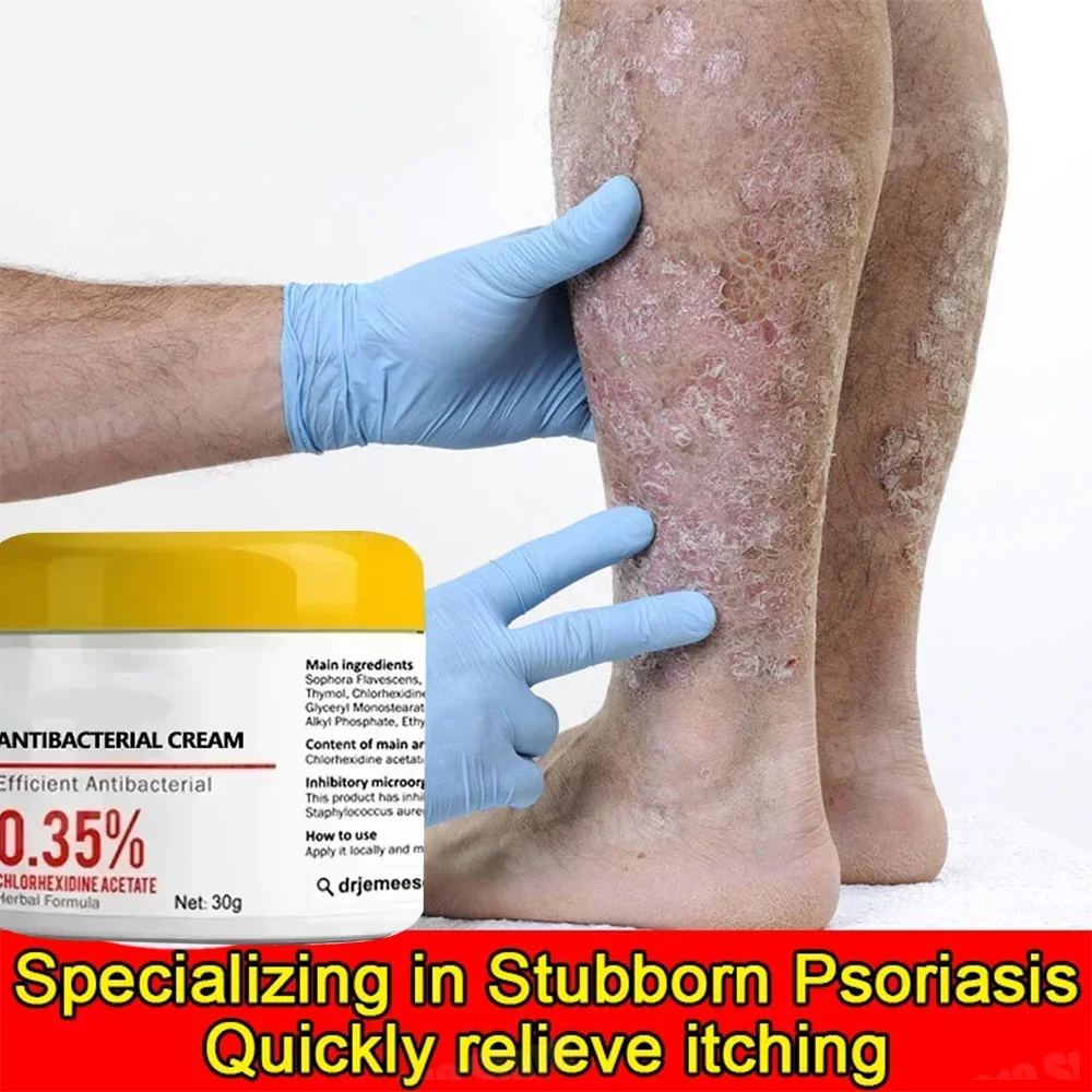 Псориаз Антибактериальный против зуда Дерматити Экзема Крапивница Алергия Кожа
