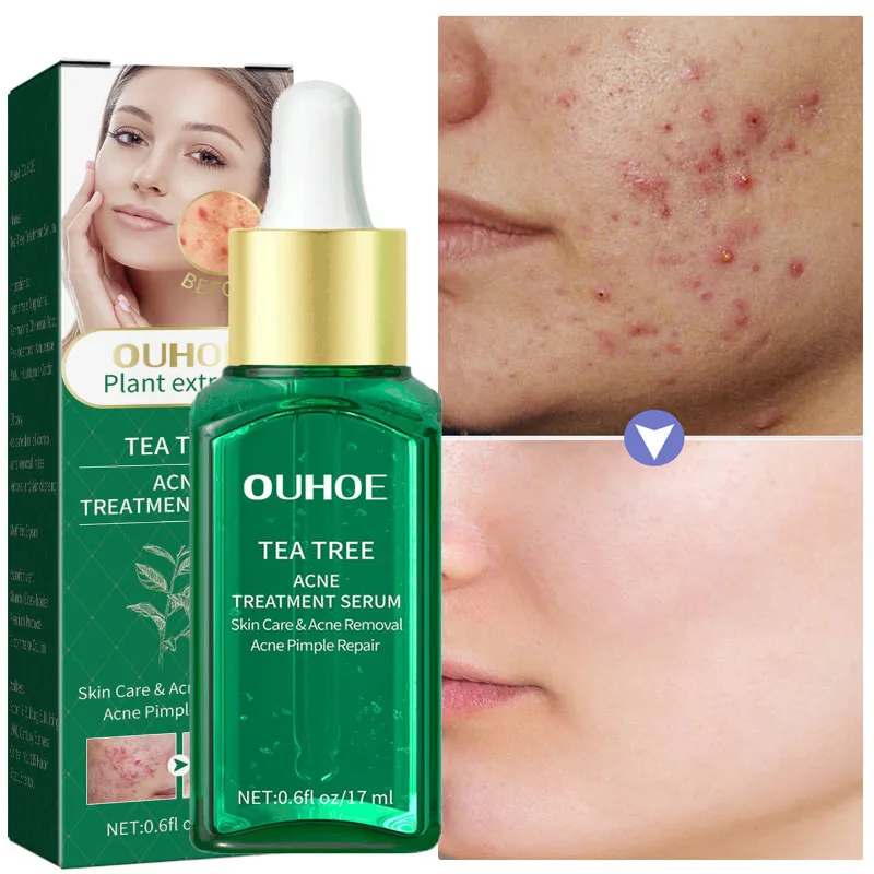 

Tea Tree Acne Treatment Serum Anti-acne Fade Acne Scars Essence Oil Control Shrink Pores Moisturizing Remove Blackhead Skin Care