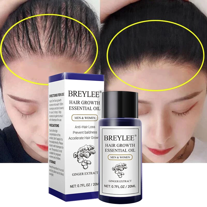

Продукты для роста волос BREYLEE, имбирное быстрорастущее эфирное масло, предотвращающее выпадение волос, косметическое средство, восстановле...