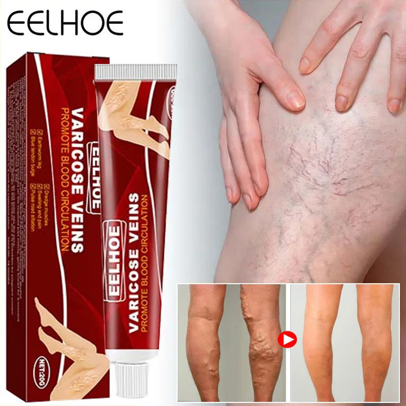 

20g Varicose Veins Treatment Cream Vasculitis Phlebitis Spider Pain Relief Ointment Promote Blood Circulation Legs Health Care