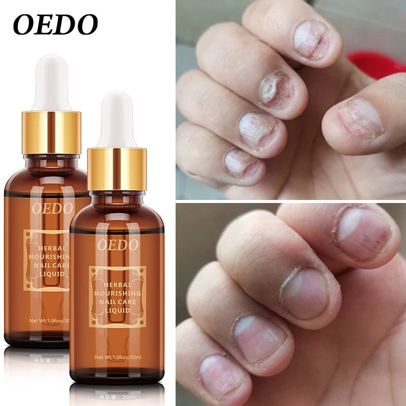 

2 шт., травяная Питательная Жидкость для ухода за ногтями