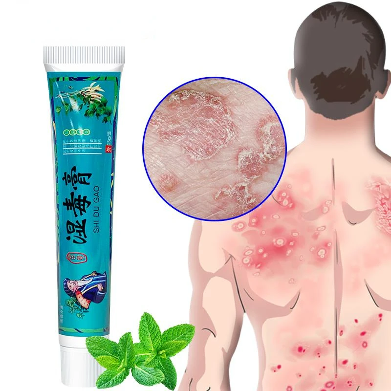 

1Pcs Psoriasis Cream Skin Care Herbal Plaster Dermatitis Eczematoid Eczema Urticaria Treatment Ointment Relieve Skin Itch S068