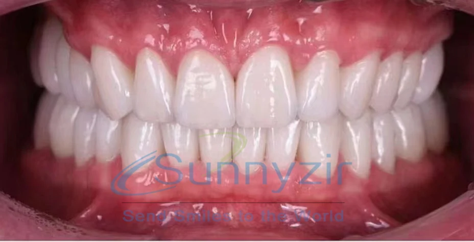 Sunnyzir  B1 4D Pro multilayer zirconia blocks in dental lab crown bridge Dental Materials for CAD/CAM Open/Amann/Zirkon System