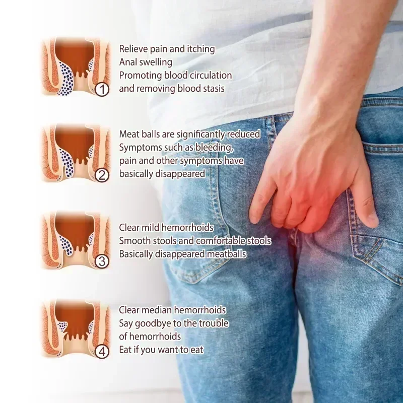 Средство для удаления геморроя NewHemorrhoid облегчение анального ануса отека лечение