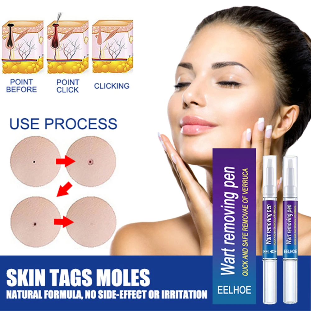 

2pcs Removing Against Moles Remover Anti Verruca Remedy Liquid Pen Treatment Papillomas Removal Of Warts Liquid From Skin Tags