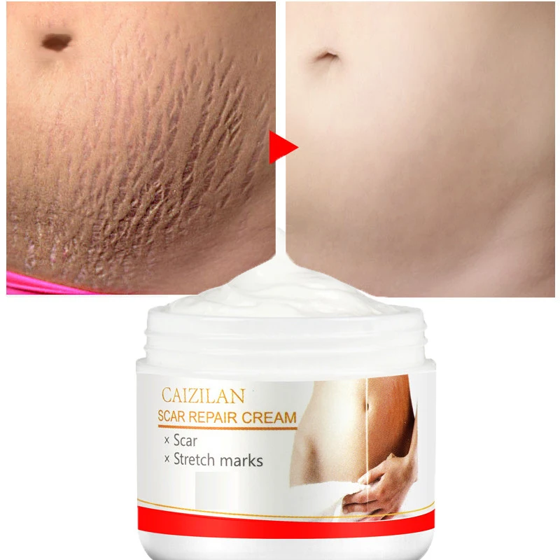 Scar Repair Cream Acne Scars Remove Pregnant Women Skin Care Stretch Marks Removal Maternity Fat Striae Gravidarum Treatment 30g