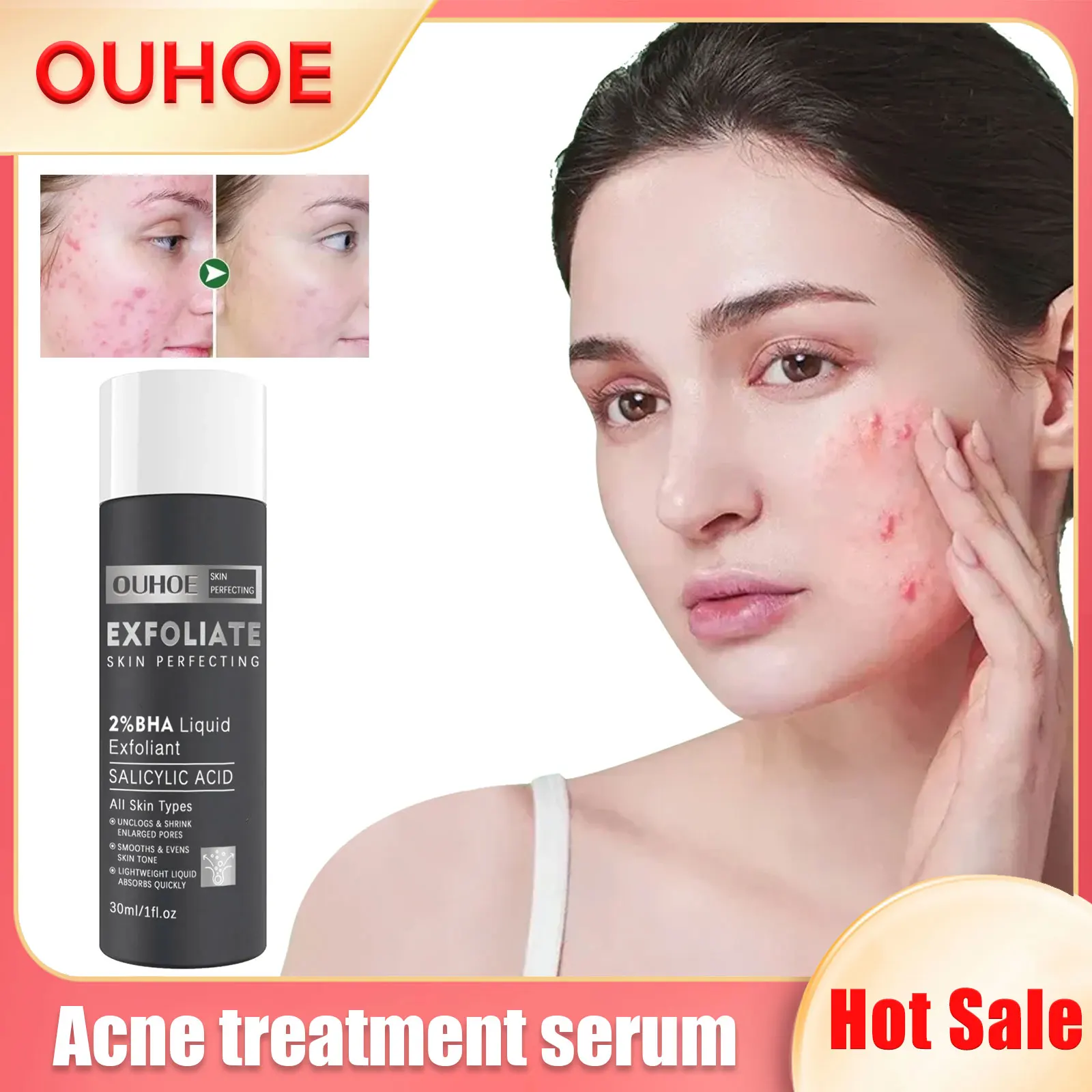 

Acne Treatment Serum Ordinary Salicylic Acid Serums Remove Pimples Blackheads Anti Acne Pores Shrink Skin Rejuvenation Essence