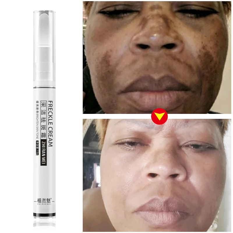 Whitening Freckle Face Cream Remove Melasma Dark Spot Niacinamide Fade Melanin Moisturizing Brighten Anti-Aging Beauty Skin Care