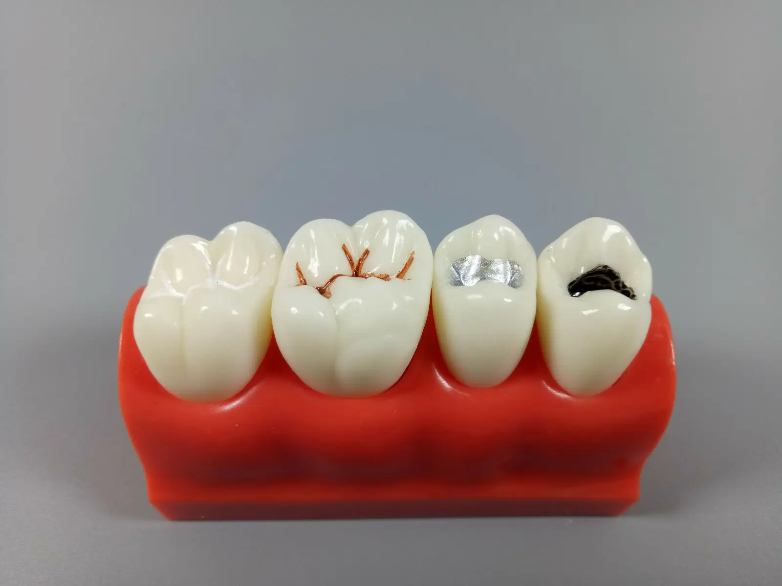 

1Piece Dental Adhesive Pit Fissure Sealant Study Model Dentist Tooth Simulation