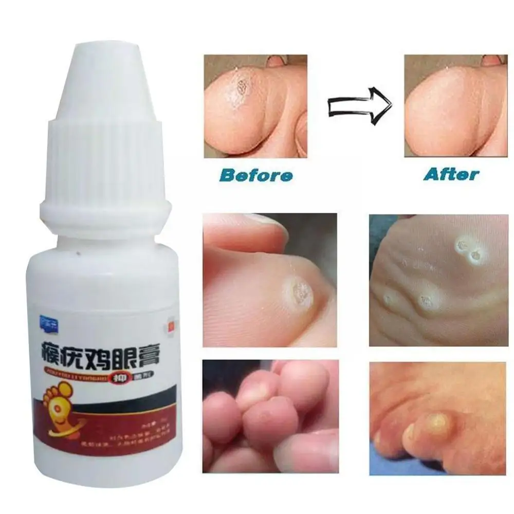 

Средство для удаления этикеток на коже, 12 часов лечения, средство для удаления пятен на коже, искусственная мазь, нож, бирка, бородавка на теле, уход за кожей, педикюр X1C6