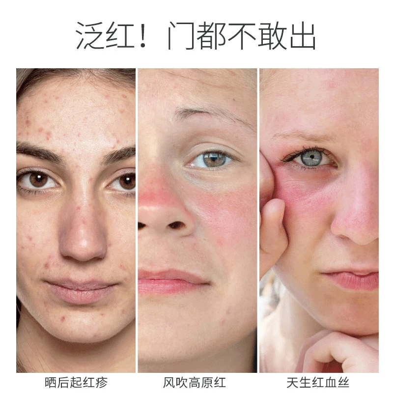 Крем от варикозного расширения вен на лице |