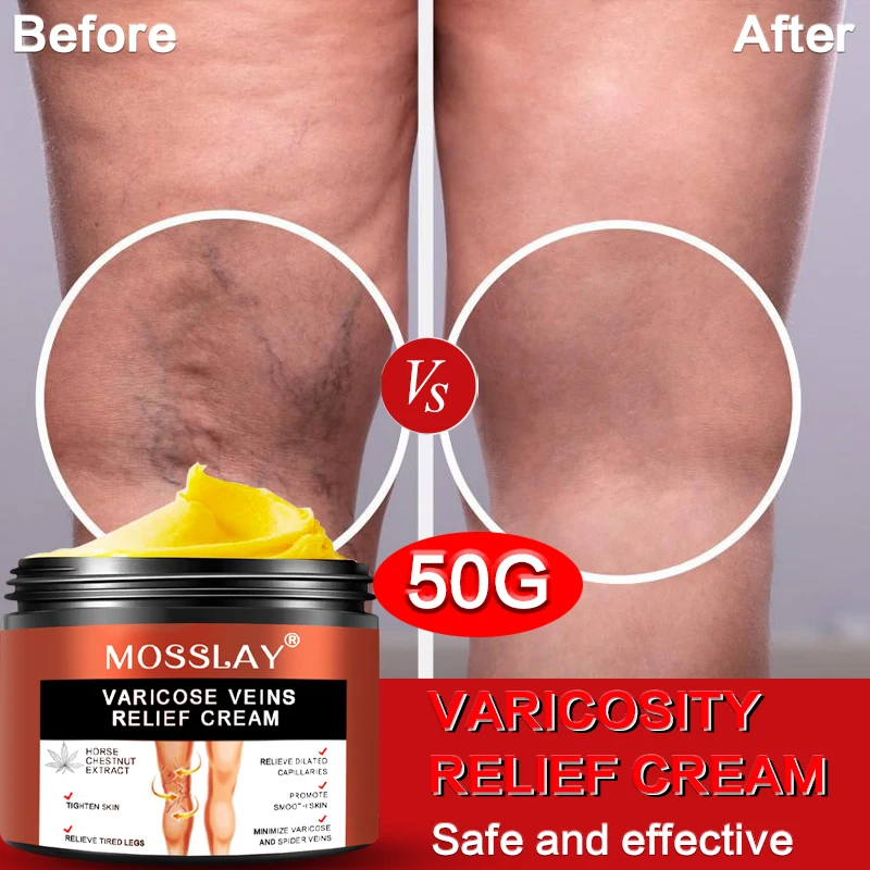 

And High Quality Vein Repair Cream Vein Cream Blue Vein Bulging Pain Leg Varicose Earthworm Leg Pulse Kang Leg Care