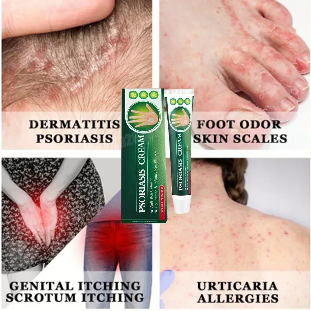 Antibacterial Cream Psoriasis Anti-itch Relief Eczema Skin Rash Urticaria Desquamation Healing