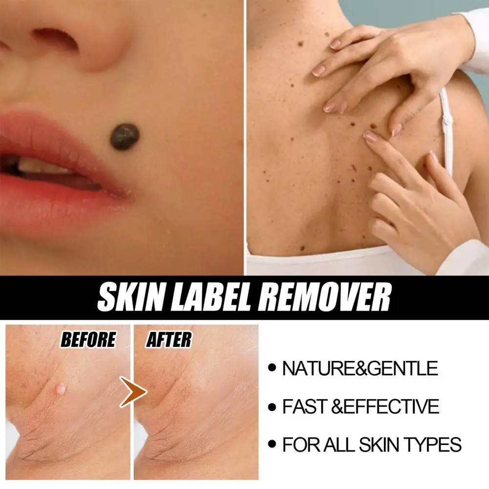 

30ml Wart Solution Natural Painless Body Care Tool Mole Skin Tag Corrector Essence Wart Remover Liquid for Women