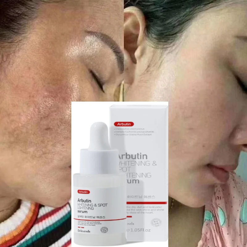 

Arbutin Remove Melasma Essence Whitening Freckle Face Serum Fade Dark Spots Melanin Brighten Skin Pigment Correction Products