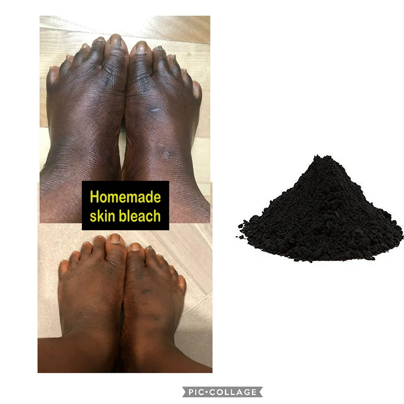 

Remove Bleaching Product Reactions on Hands and Legs At Home Whitening Cream for Dark Skin Lightening Dark Spot Remover