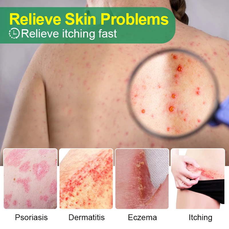 3 шт./лот Таиландские травяные кремы материал от псориаза экземы мазь крем для