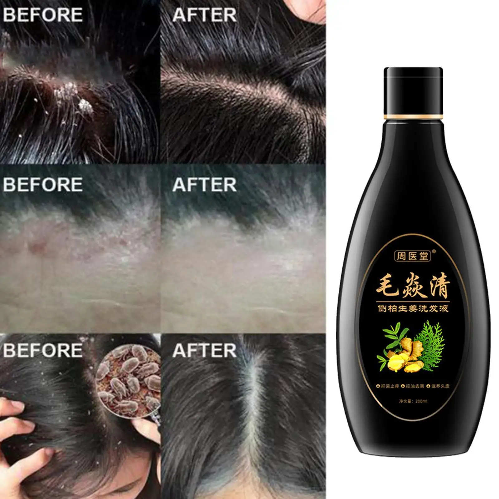 

200ml Anti-Dandruff Shampoo Scalp Hair Follicle Therapeutic Psoriasis Shampoo Anti-itching Mites Oil Control Cleansing