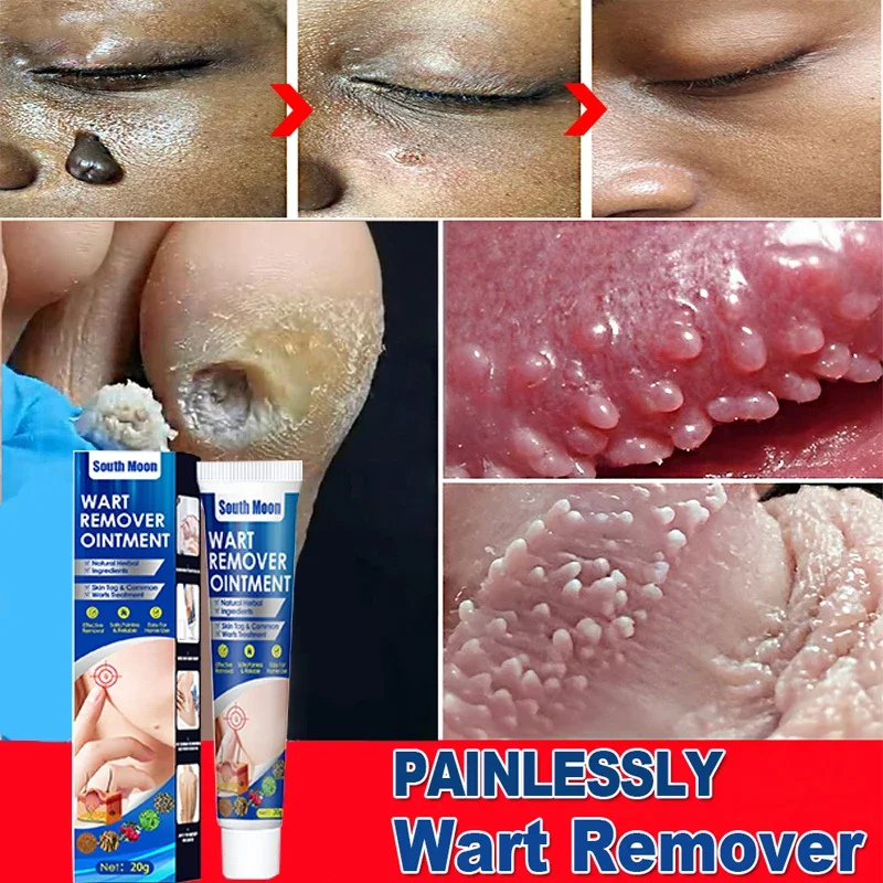 

Wart Remover Cream Clean Painless Mole Skin Dark Spot Warts Remover Face Wart Tag Treatment Men Women cream Body Skin Care