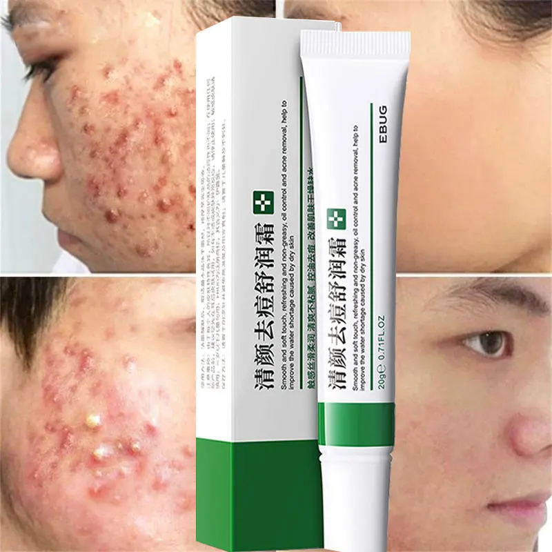 

20g Effective Acne Marks Removal Cream Lighten Acnes Scars Moisturizing Oil Control Shrink Pores Whitening Face Cream Skin Care