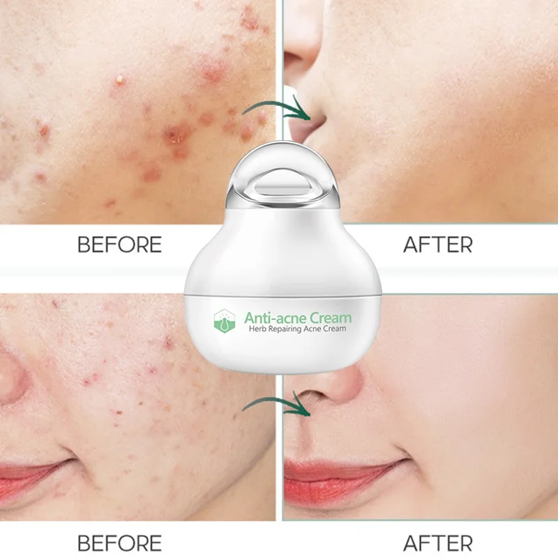 

Herbal Acne Removal Cream Anti-Acne Shrink Pores Oil Control Reduce Redness Gentle Repair Skin Moisturize Facial Cream Skin Care