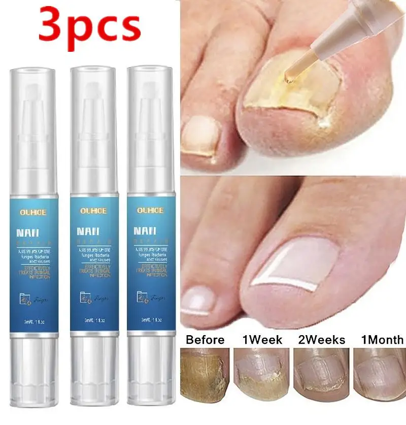 

3 шт., сыворотка для удаления грибка на ногтях, с экстрактом онихомикоза