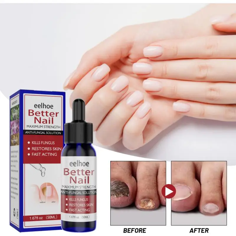 

EELHOE50ml Fungal Nail Repair Essence Serum Care Treatment Foot Nail Fungus Removal Gel Anti Infection Paronychia Onychomycosis