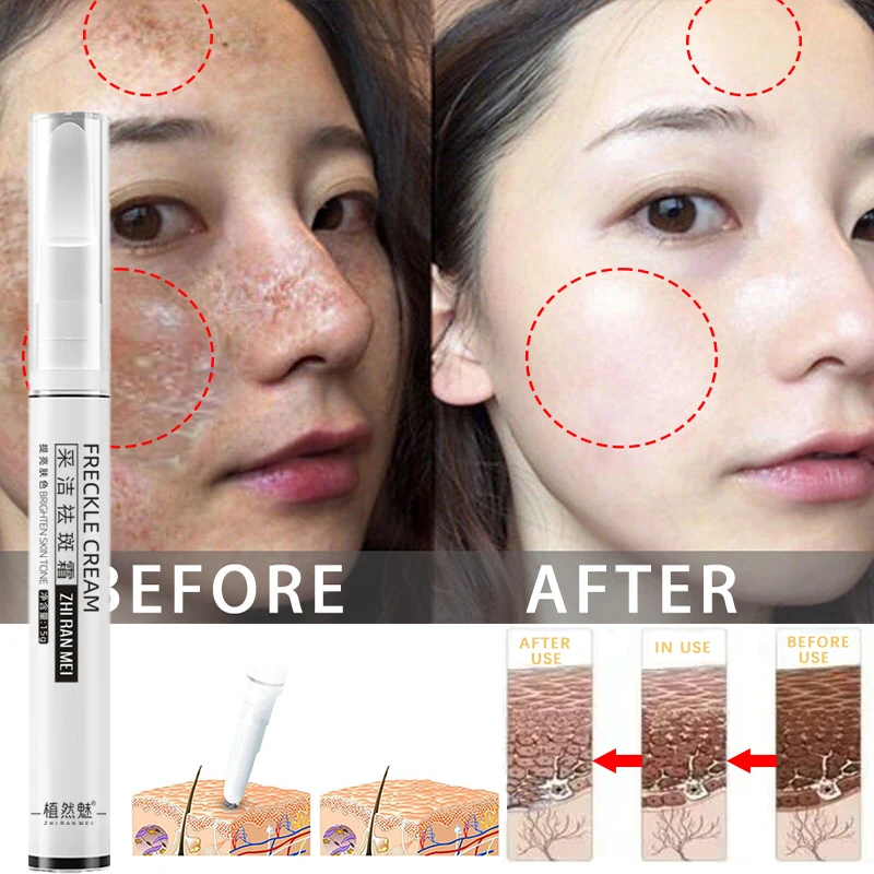 

10 шт. отбеливающий крем для веснушек, удаление темных точек, осветление, удаление мелазмы, увлажнение, осветление, уход за кожей лица