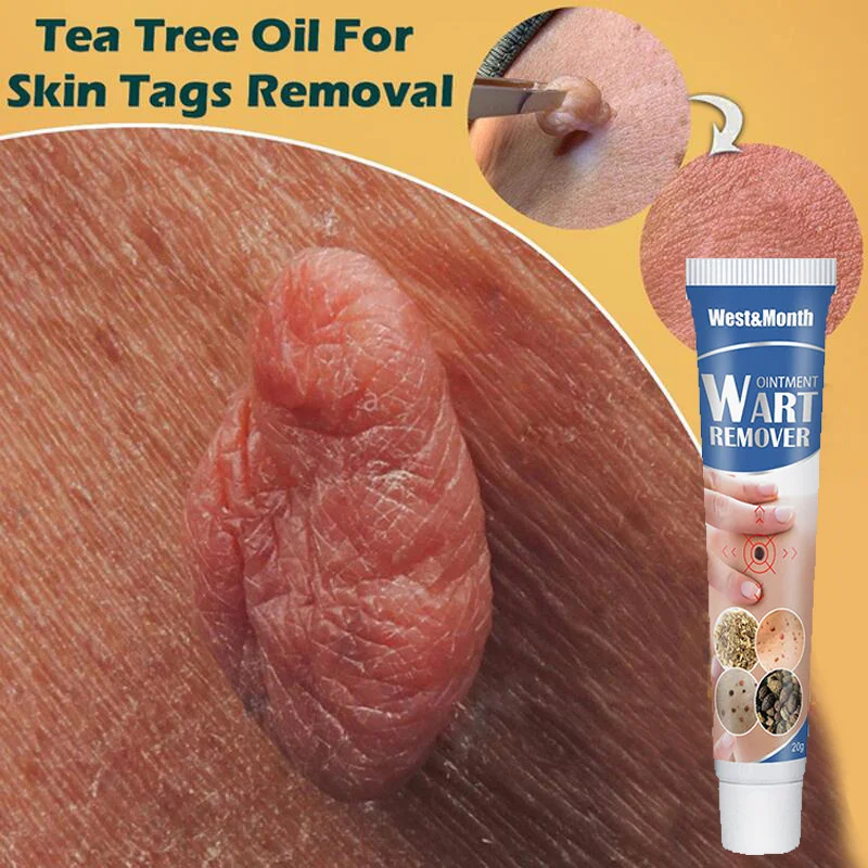 

1pcs Warts Remover Ointment Wart Treatment Cream Neck Skin Tag Armpit Flat Wart Genitals Wart Antibacterial Skin Beauty Products