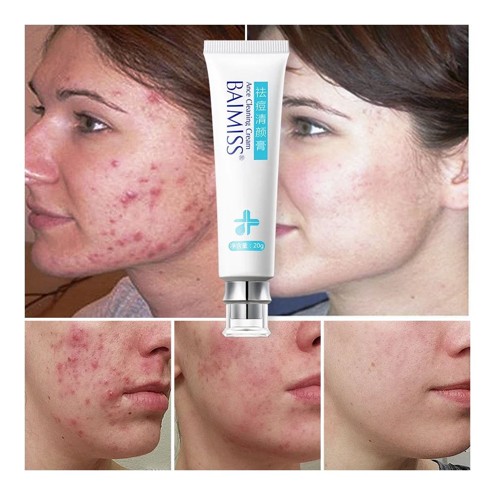 2 шт. натуральный Лечебный крем для удаления акне |