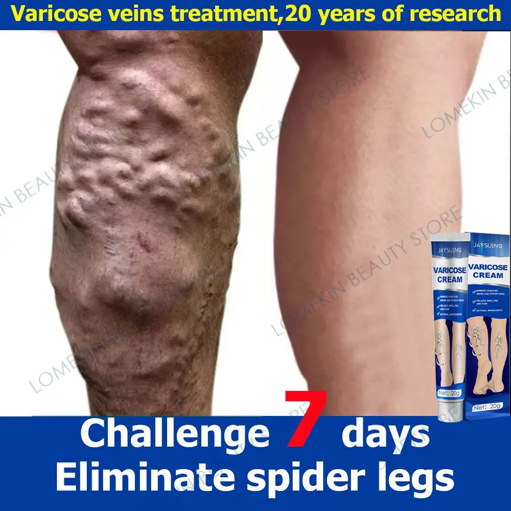 

Effective Varicose Vein Relief Cream Relieve Vasculitis Phlebitis Spider Legs Pain Swelling Treatment Herbal Massage Ointment