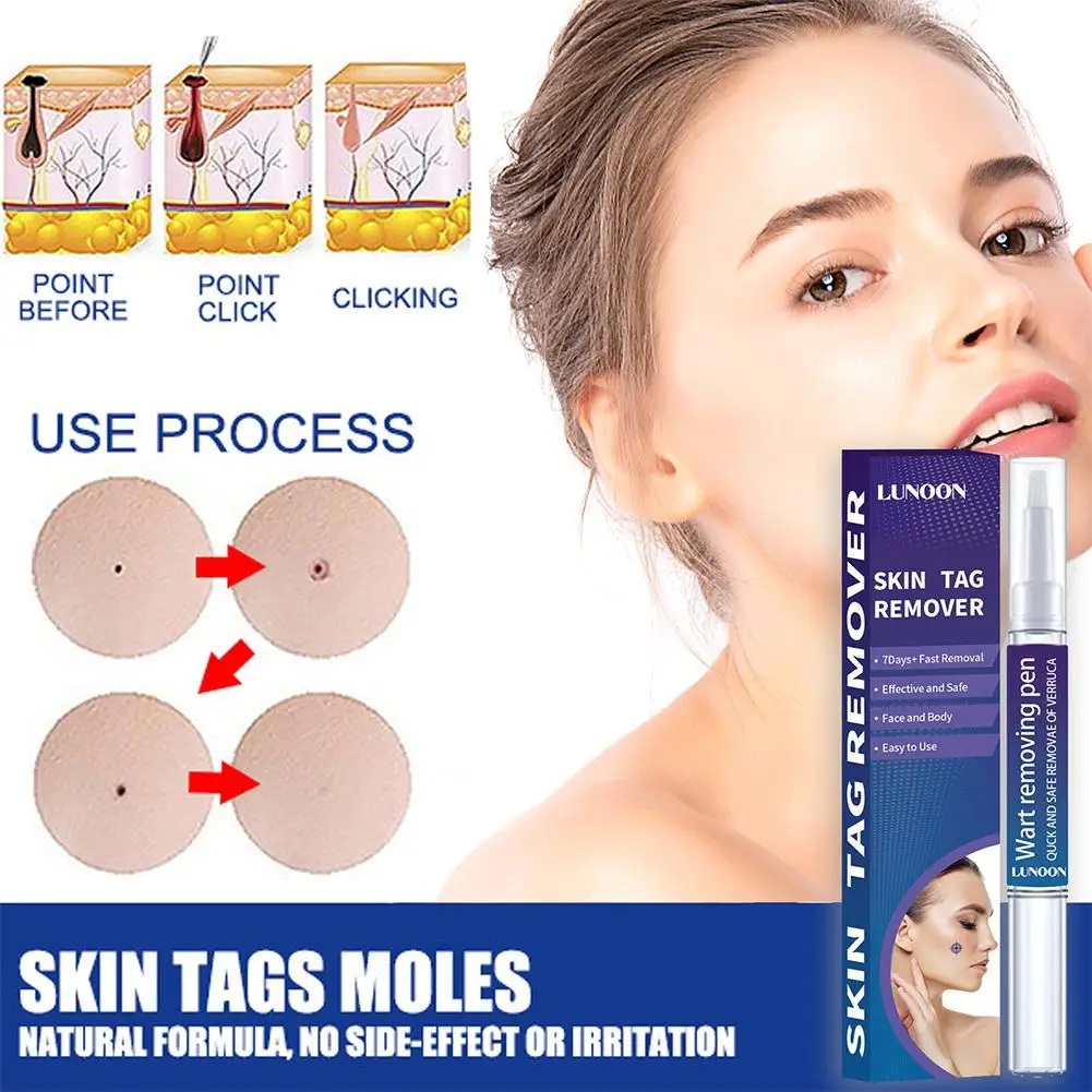 

Keyu Liquid Pen Keyu Removing Corns Meat Granules Flat Removal Plantar Warts Nevus Cream Brightening Keyu Skin Skin Spot J4J5