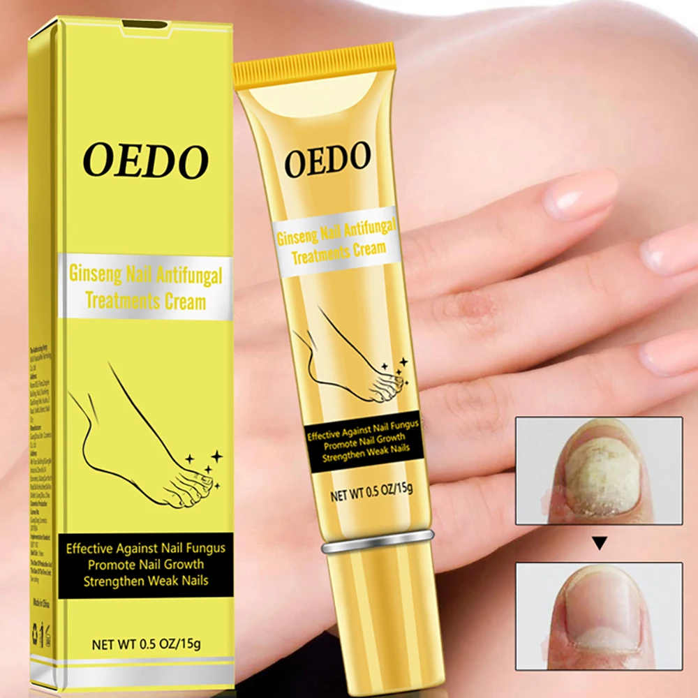

OEDO Ginseng Nail Antifungal Treatments Cream Removal Gel Anti Infection Paronychia Onychomycosis Promote Nail Growth Nails Care