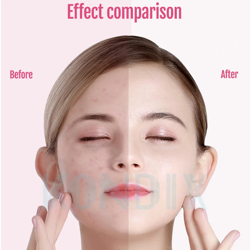 Ultrasonic Skin Scrubber Deep Face Cleaning Machine Peeling Shovel Facial Pore Cleaner Lift New |