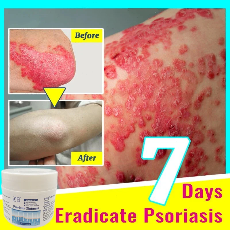 1/3/5 шт. крем против зуда от псориаза экземы дерматита антибактериальная мазь для