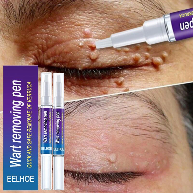 

Wart Removal Mole Remedy Liquid Pen Antibacterial Painless Treatment Papillomas Removing Flat Wart Genitals Beauty Herbal Cream