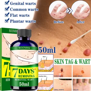 50mlTreatment Papillomas Removal of Warts Liquid kill Remover Foot Corn Skin Tag Mole & Genital W