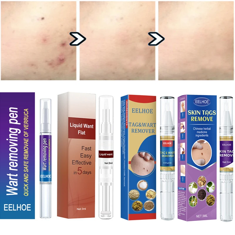 

4 Type Removing Against Moles Remover Anti Verruca Remedy Liquid Pen Treatment Papillomas Removal of Warts Liquid From Skin Tags