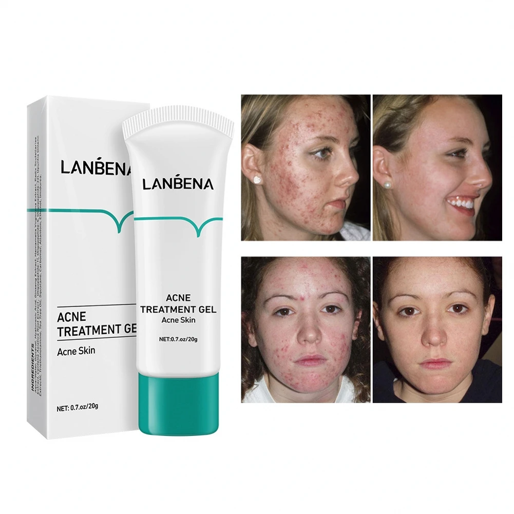 

Acne Treatment Cream Face Clean Effective Fade Marks Scars Repair Damaged Skin Remove Blackheads Pimples Gel Oil Control