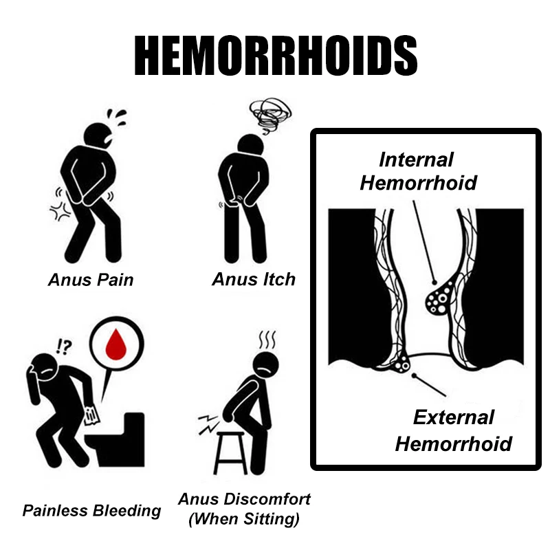 1Pcs Hemorrhoid Treatment Cream Removal Internal External Anal Fissure Bloody Chinese Medicine Pain Relief G003 |