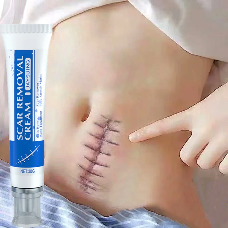 

Scar Removal Cream Gel Treatment Stretch Marks Burn Remove Acne Spots Surgical Scar Repair Cream Acne Smoothing Skin Beauty