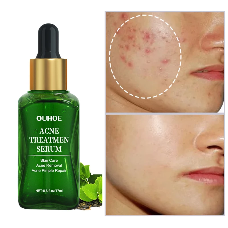 

17ml Tea Tree Facial Acne Removal Serum Hyaluronic Moisturizing Shrink Pores Oil-control Lighten Acne Marks Acne Face Skin Care