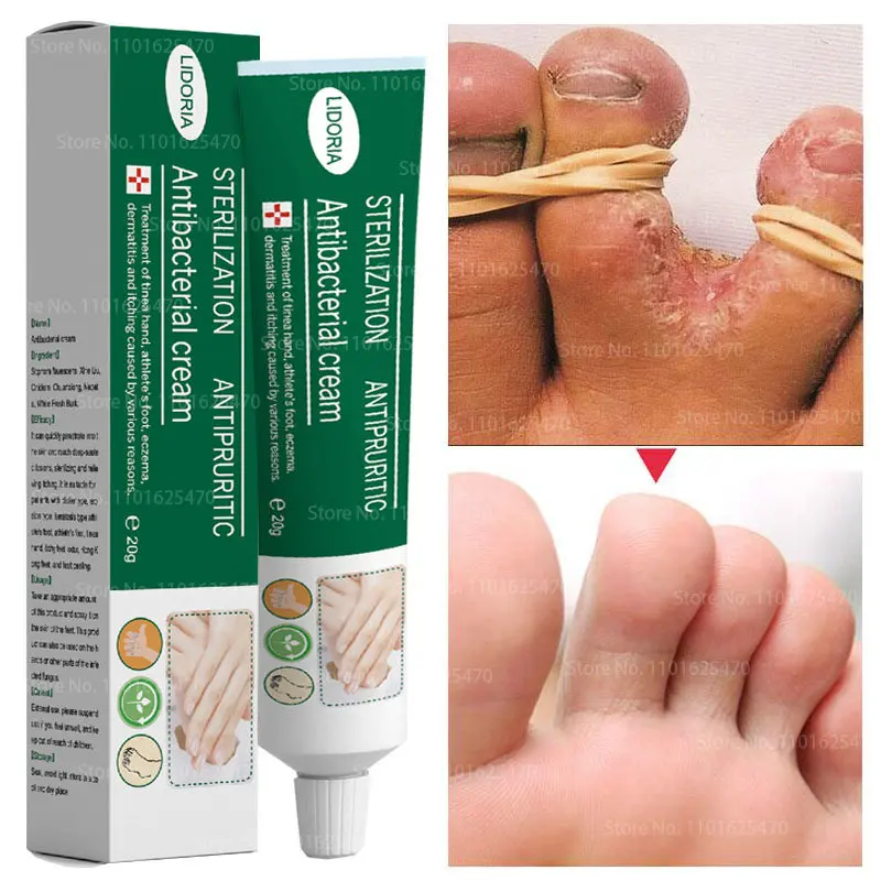 

Herbal Foot Fungus Removal Cream Nail Care Ointment Anti Fungal Infection Onychomycosis Paronychia Toe Fungus Repair Feet Care