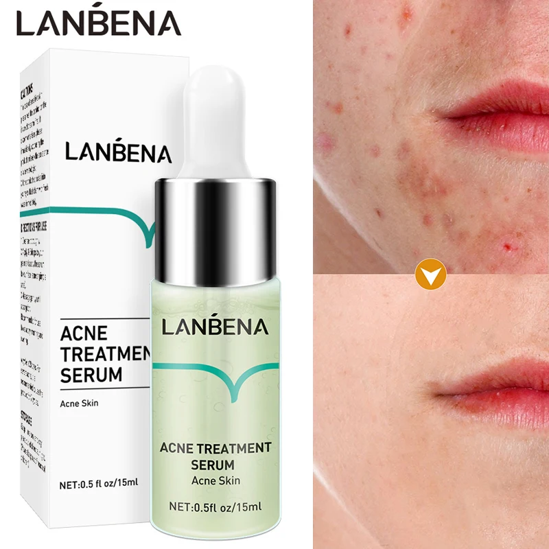

LANBENA Acne Treatment Face Serum Blackhead Pimple Spots Removal Gel Oil Control Shrink Pores Whitening Repair Facial Skin Care
